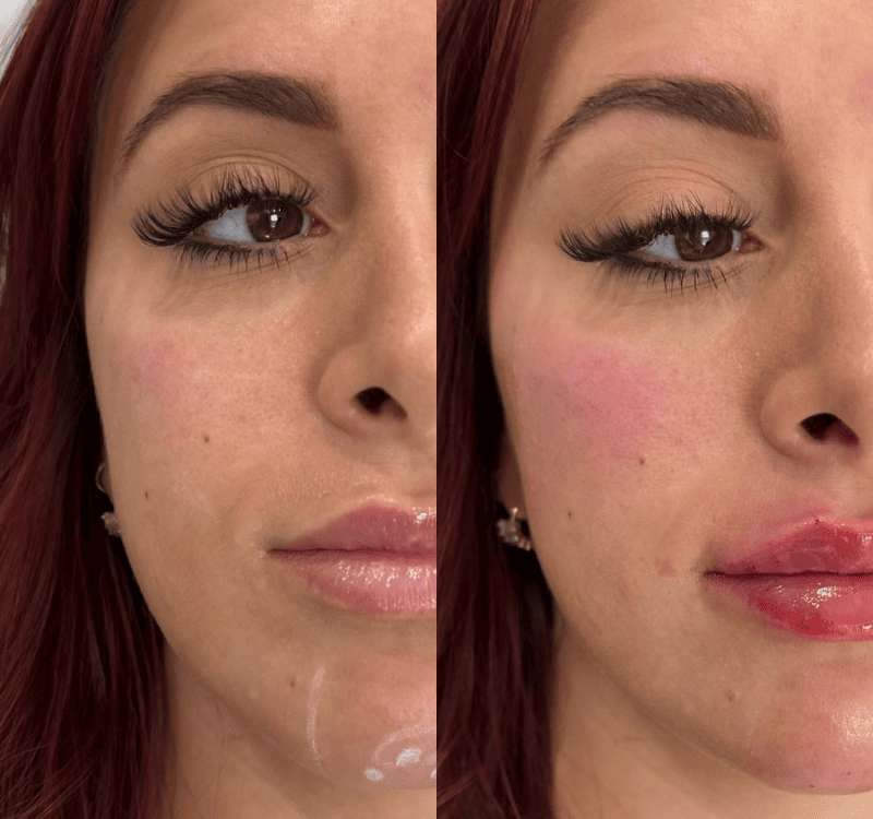 Cheek pop Before & After Treatment photos| Lips and Drips by Erica Marie in Philadelphia, PA