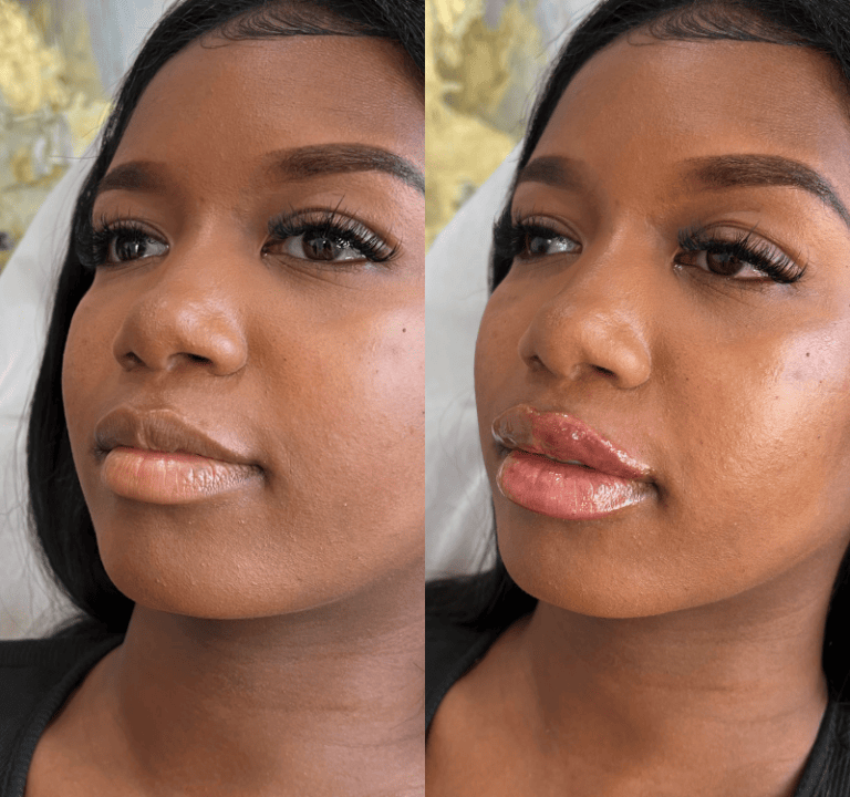 Dermal Fillers in Philadelphia, PA Lips and Drips by Erica