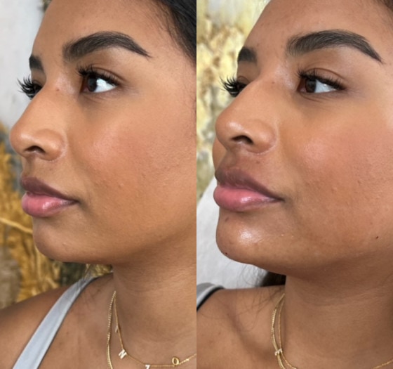 Chin pop lips and drips before & after Treatment result in Philadelphia, PA | Lips and Drips by Erica Marie LLC