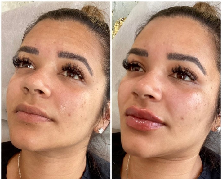 Lip Filler Before and After Treatment Photos | Lips and Drips by Erica Marie in Philadelphia, PA