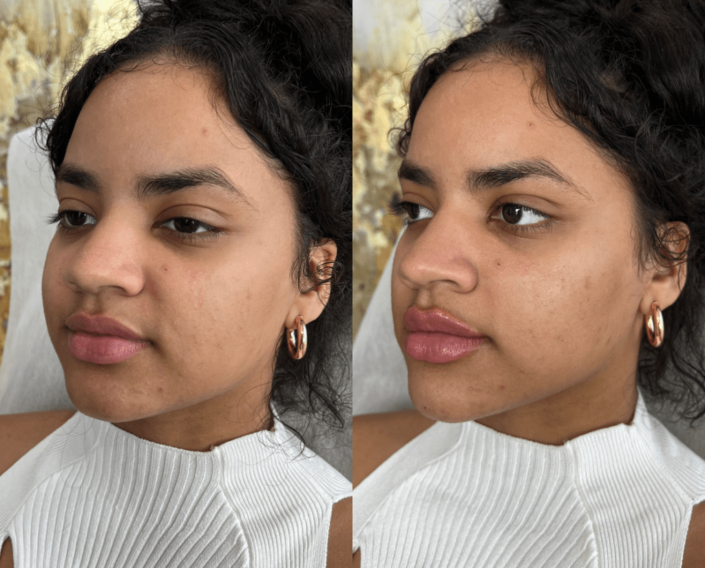 Dermal Fillers in Philadelphia, PA Lips and Drips by Erica