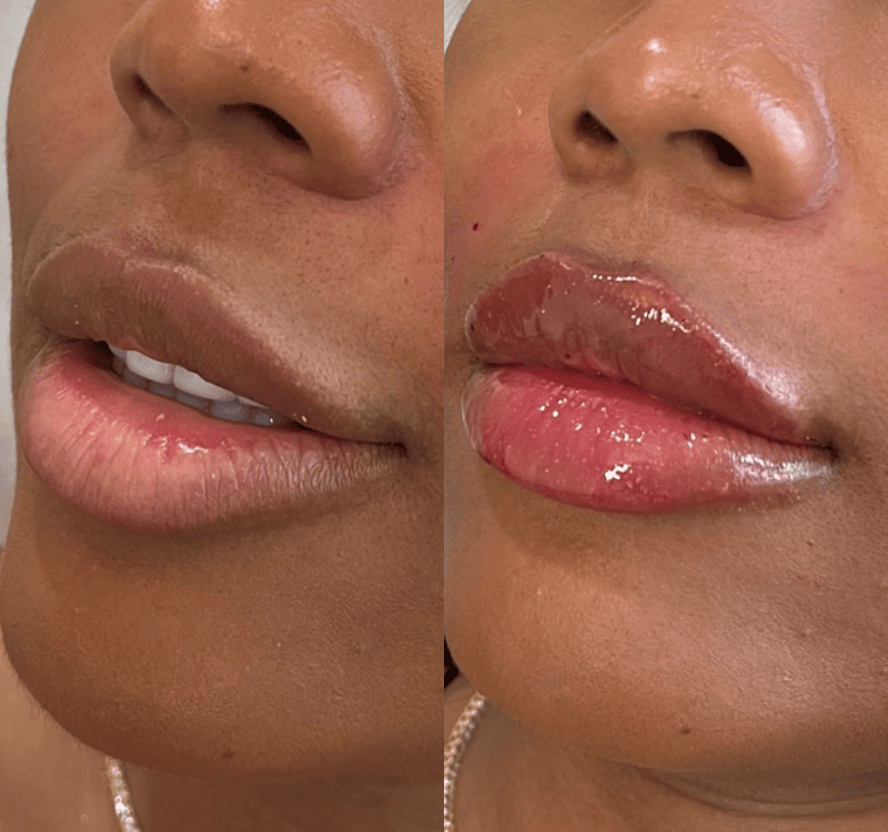 Lip Filler Before and After Photos | Lips and Drips by Erica Marie in Philadelphia, PA