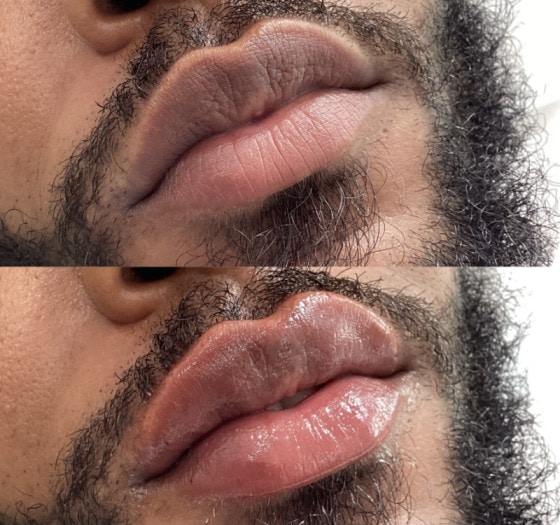 Lip Filler Before and After Treatment Photos | Lips and Drips by Erica Marie in Philadelphia, PA
