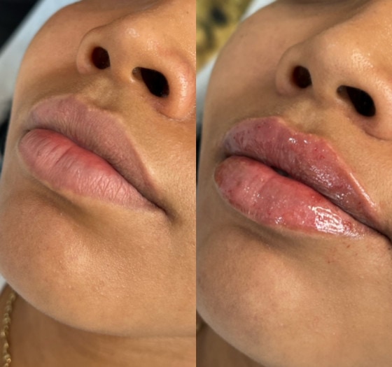 Lip Filler Before and After Photos | Lips and Drips by Erica Marie in Philadelphia, PA