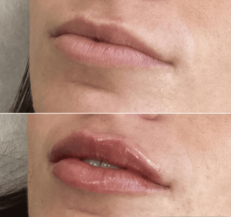 Mini-lips-plump | Lips and Drips by Erica Marie in Philadelphia, PA