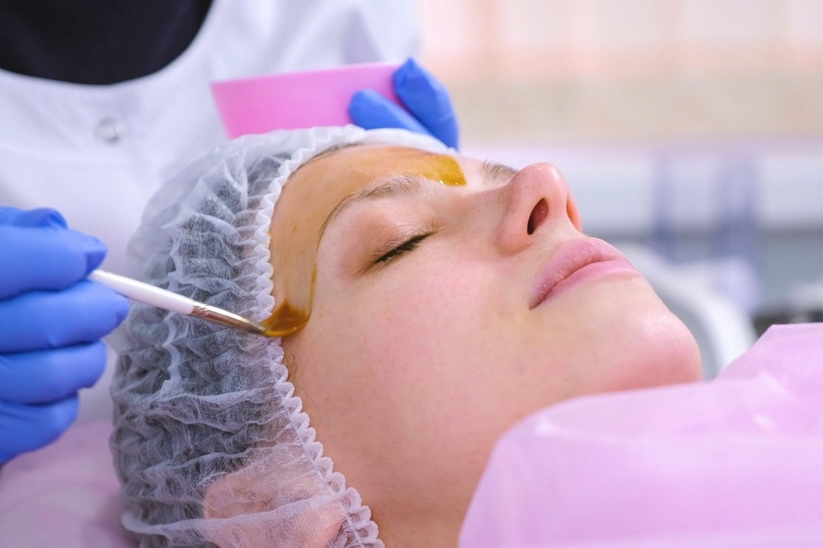 What Can You Not Do After a Chemical Peel