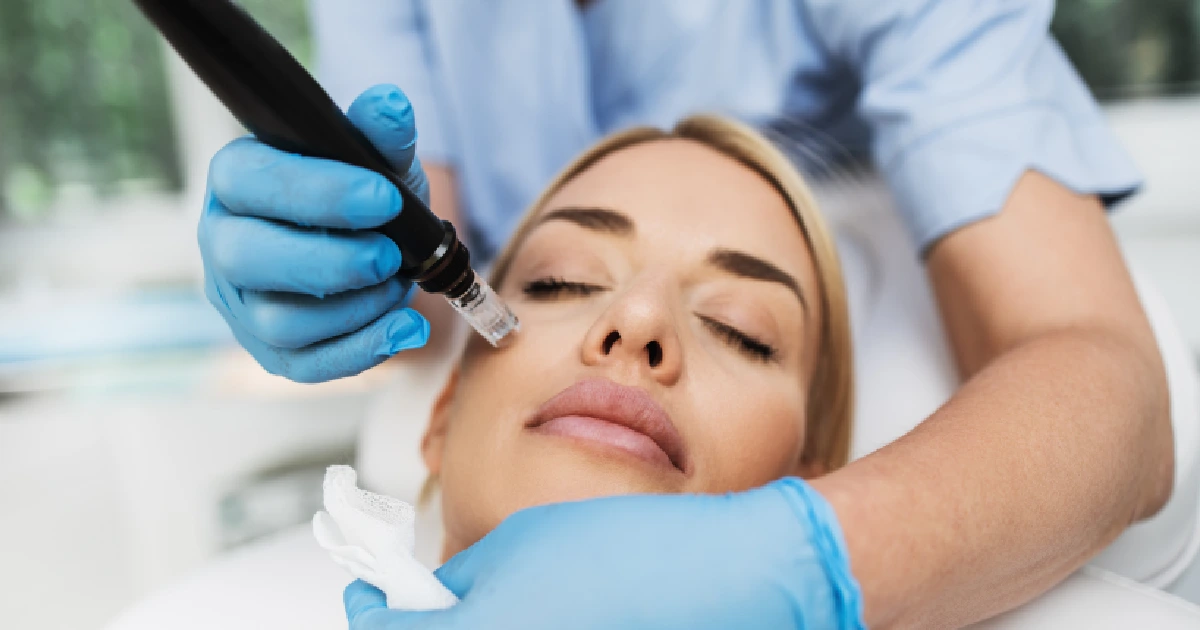 A women Receiving Microneedling in Philadelphia, PA,