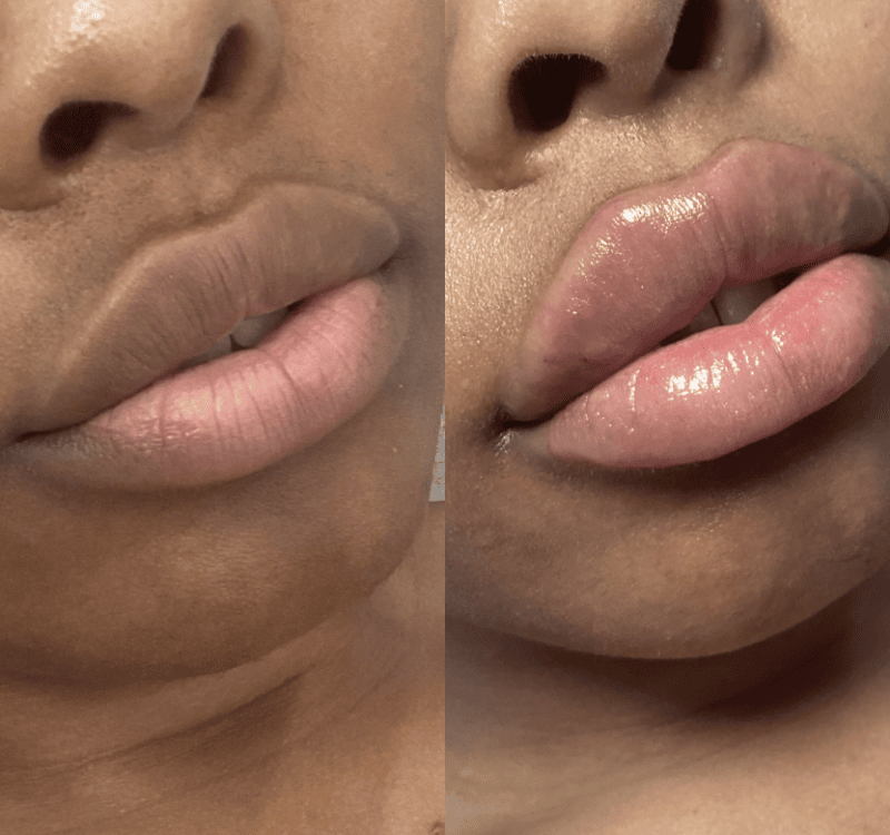 Mega-lip-babe Before and After Treatment Photos | Lips and Drips by Erica Marie in Philadelphia, PA